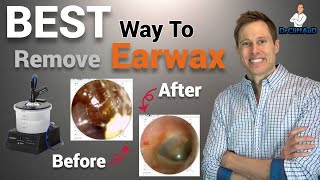 The BEST Way to Professionally Remove Earwax  Earigator Cerumen Irrigation [upl. by Anade403]