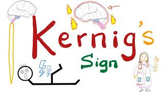 Kernig Sign  Meningitis  Neurology Physical Exam [upl. by Hedaza574]