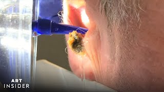 Water Device Painlessly Removes Earwax  Art Insider [upl. by Jaynes]