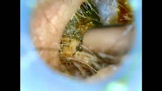 Satisfying Ear Wax Removal Compilation 1 [upl. by Anaes120]