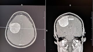 Brain Tumor Symptoms Described [upl. by Vail]