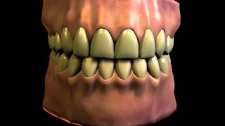 Dental Bruxism Teeth Grinding [upl. by Erica]