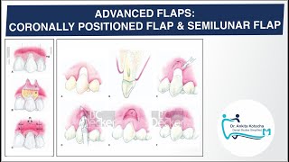 ADVANCED PEDICLE FLAPS CORONALLY POSITIONED FLAP SEMILUNAR FLAP ROOT COVERAGE DR ANKITA [upl. by Hamlani]