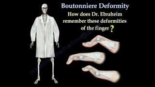 Boutonniere Deformity  Everything You Need To Know  Dr Nabil Ebraheim [upl. by Moureaux382]