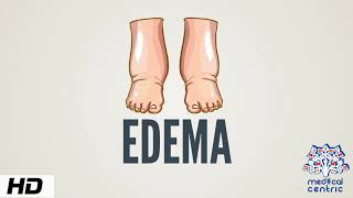 Edema Causes Signs and Symptoms Diagnosis and Treatment [upl. by Piers972]