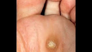 What Are Plantar Warts Dr Mikkel Jarman Pediatric Podiatrist [upl. by Huttan]