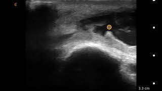 Image Interpretation Olecranon Bursitis [upl. by Nyllaf]