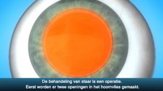 Staaroperatie cataract  OLVG Oogheelkunde [upl. by Ranzini539]