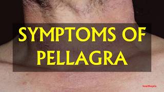 SYMPTOMS OF PELLAGRA [upl. by Atiseret]