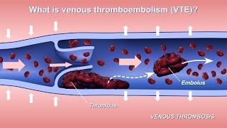 Understanding and Diagnosing Venous Thromboembolism VTE [upl. by Rodriguez620]