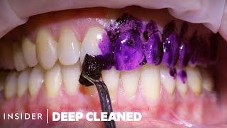 How Teeth Are Professionally Deep Cleaned  Deep Cleaned [upl. by Llovera269]