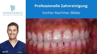 Professionelle Zahnreinigung VorherNachherBilder [upl. by Ivey]