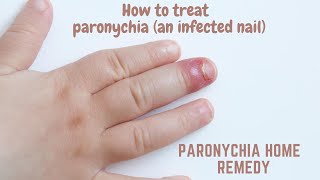 Paronychia home remedy  How to treat paronychia an infected nail [upl. by Kalfas486]