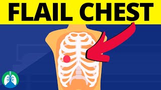 Flail Chest Medical Definition  Chest Trauma [upl. by Saba]