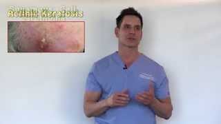 PreCancers or Actinic Keratosis Treatment Options With Dr Timothy Jochen [upl. by Wong]