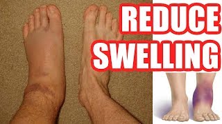 How to Reduce Swelling Make Your Swelling Go Down Easy Methods [upl. by Assirral]