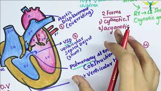 Mayo Clinic – Tetralogy of Fallot [upl. by Seem657]