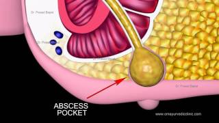 How long do fissures take to heal How are they different from piles  Dr Rajasekhar M R [upl. by Nylehtak40]