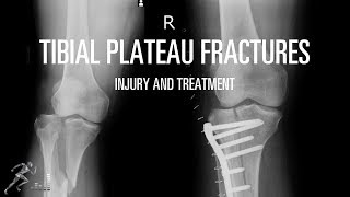 AO Trauma Pediatric Femur—Proximal Sub trochanteric fracture fixation by elastic nails [upl. by Iadam578]