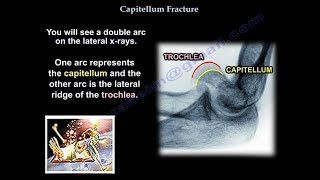 Capitellum Fracture  Everything You Need To Know  Dr Nabil Ebraheim [upl. by Aznarepse]