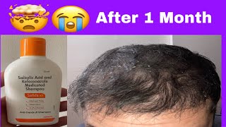 Salisia KT shampoo honest review after 1 month of use  Best anti Dandruff shampoo hair transplant [upl. by Zaragoza140]