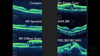 Macular OCT Interpretation A Practical Discussion with Dr David E Lederer [upl. by Michel33]