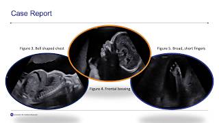 Patient Perspective Congenital hip dysplasia [upl. by Lymn560]