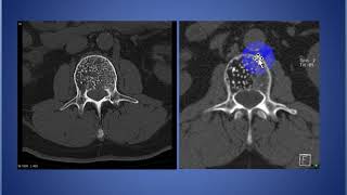 Vertebral Haemangioma [upl. by Hegarty543]