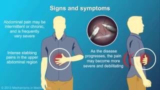 Chronic Pancreatitis [upl. by Deehan]