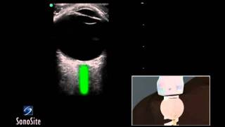 Ophthalmology  Relative Afferent Pupillary Defect RAPD [upl. by Judye]