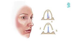 Rhinoplasty Detailed animation about the operation [upl. by Reniti]