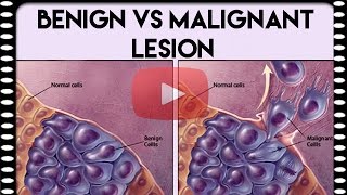 Medical Coding Basics — Benign vs Malignant Lesion [upl. by Krutz]