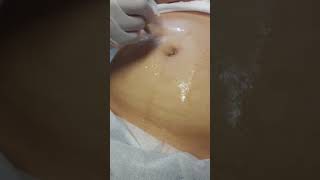 Eliminación de estrías con Dermapen  Microneedling [upl. by Aivle]