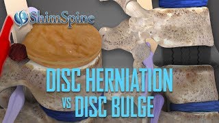 Disc Herniation vs Disc Bulge [upl. by Ingunna]