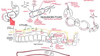 Microbiology  Helicobacter Pylori Ulcer [upl. by Stutman]