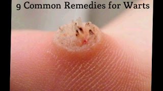 9 Common Remedies for Warts [upl. by Hillinck]