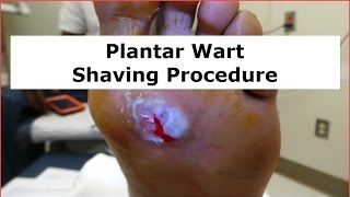 Plantar Wart Shaving Procedure [upl. by Madelon]