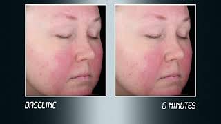 Het effect van Mirvaso gel op rosacea [upl. by Annah]