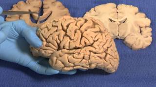 Limbic Neuroanatomy Video Lab  Brain Dissections [upl. by Ravi325]