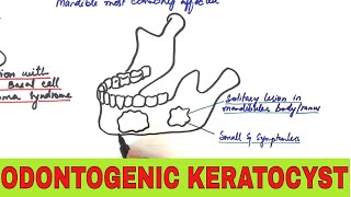 Odontogenic Keratocyst  Clinical Radiographic and Histopathologic Features [upl. by Lertnek]