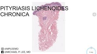 Pityriasis Lichenoides Chronica Dermpath Made Easy [upl. by Ober]